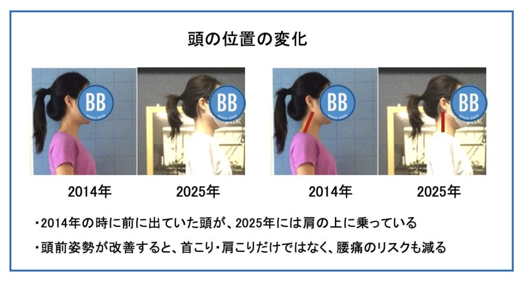ピラティススタジオBB 田町の会員様の10年間のピラティス実践における頭前姿勢改善の比較写真