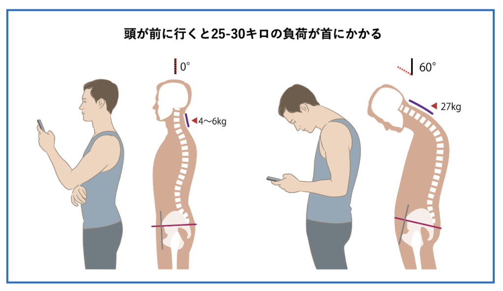 フォワードヘッド姿勢だと、頸椎に25-30kg負担がかかることを解説したイラスト
