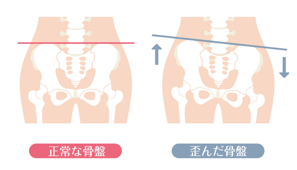 正常な骨盤と左右差のある骨盤を比較したイラスト。骨盤の高さの違いによる姿勢の歪みを示す図