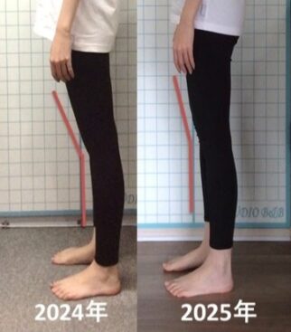 ピラティススタジオBB錦糸町のH.Y様(20代女性)の成果。反張膝が改善され、脚のラインがまっすぐになってきた比較写真。