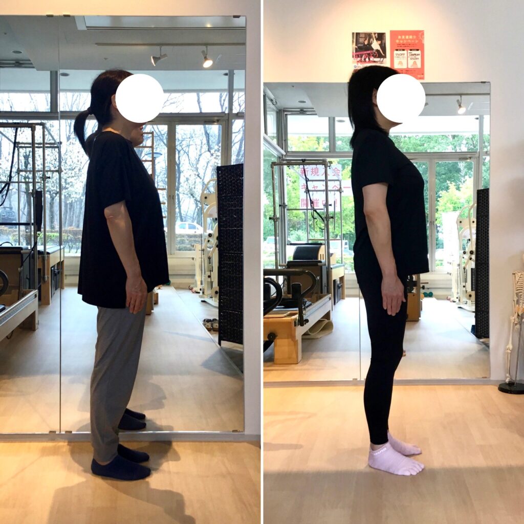 ピラティススタジオBB仙台泉店に通う会員様の横向きからの比較写真。頭の位置、骨盤の位置が後ろへ戻り、真っ直ぐな立ち姿に改善。