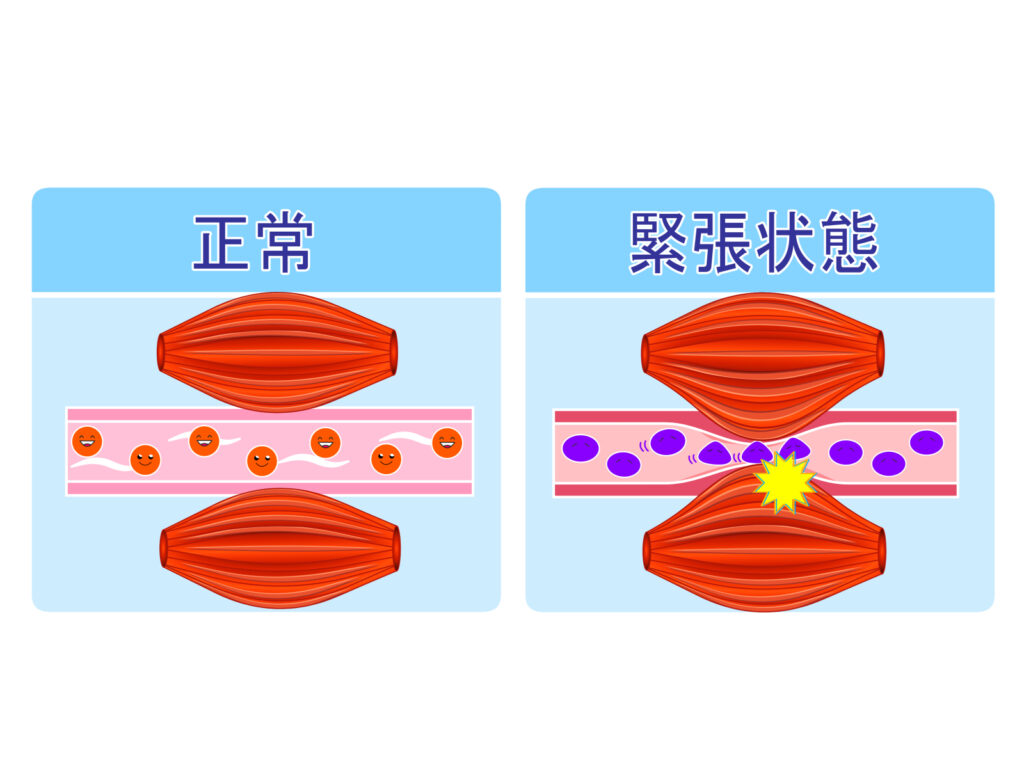 筋肉の緊張が血流の妨げをする場合がるというイラスト。