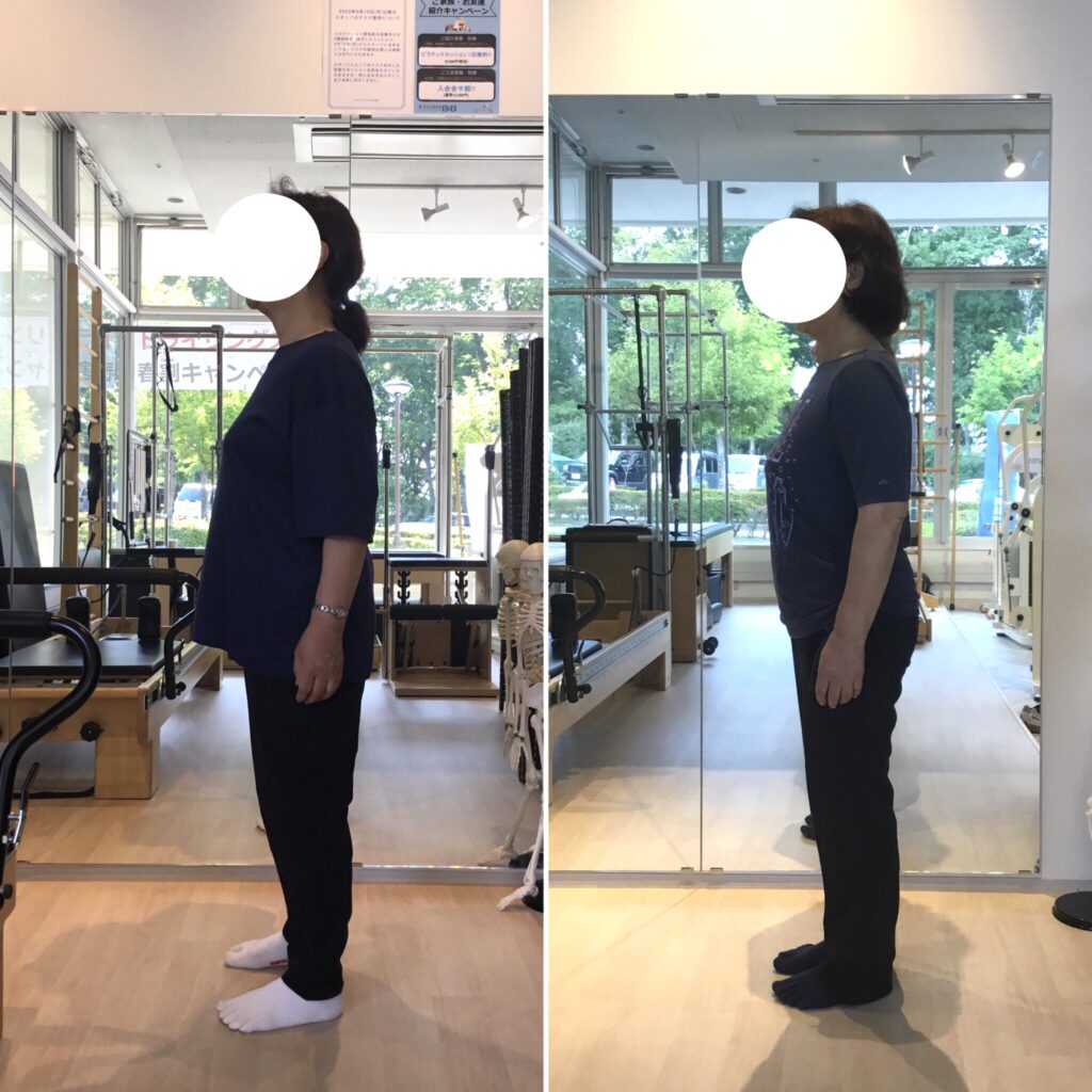 ピラティススタジオBB仙台泉店に通う70代女性の横からの姿勢比較写真の画像
