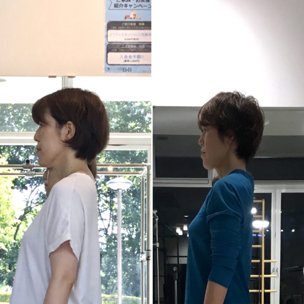 上半身を比較した姿勢写真。首の位置が改善され、背中の丸みや頭の位置も改善されている。