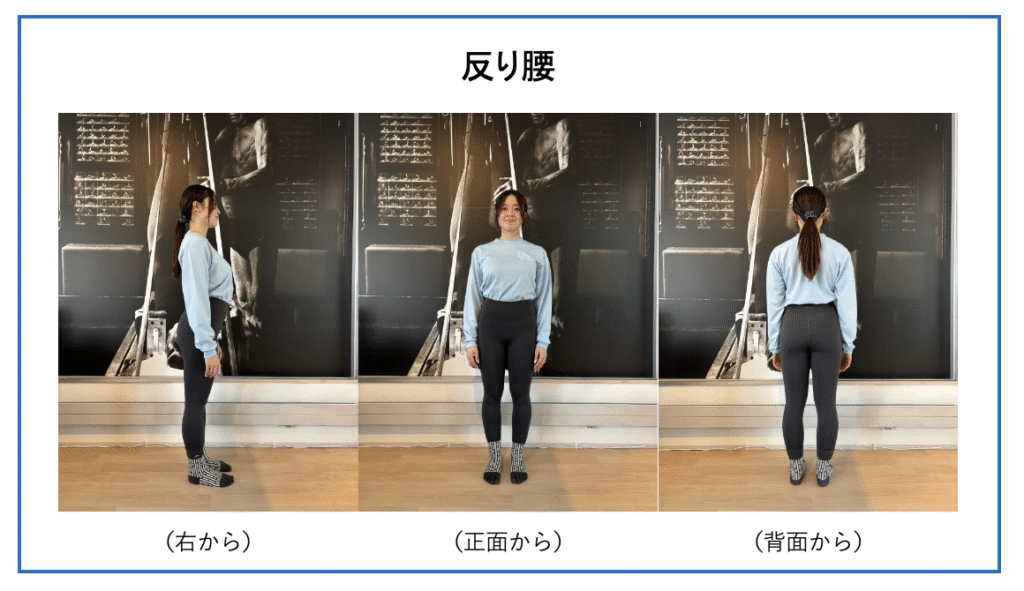反り腰を横・正面・背面から撮影した画像