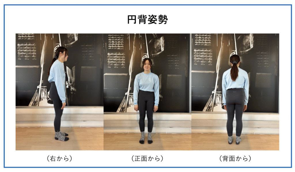 円背姿勢を横・正面・背面から撮影した画像