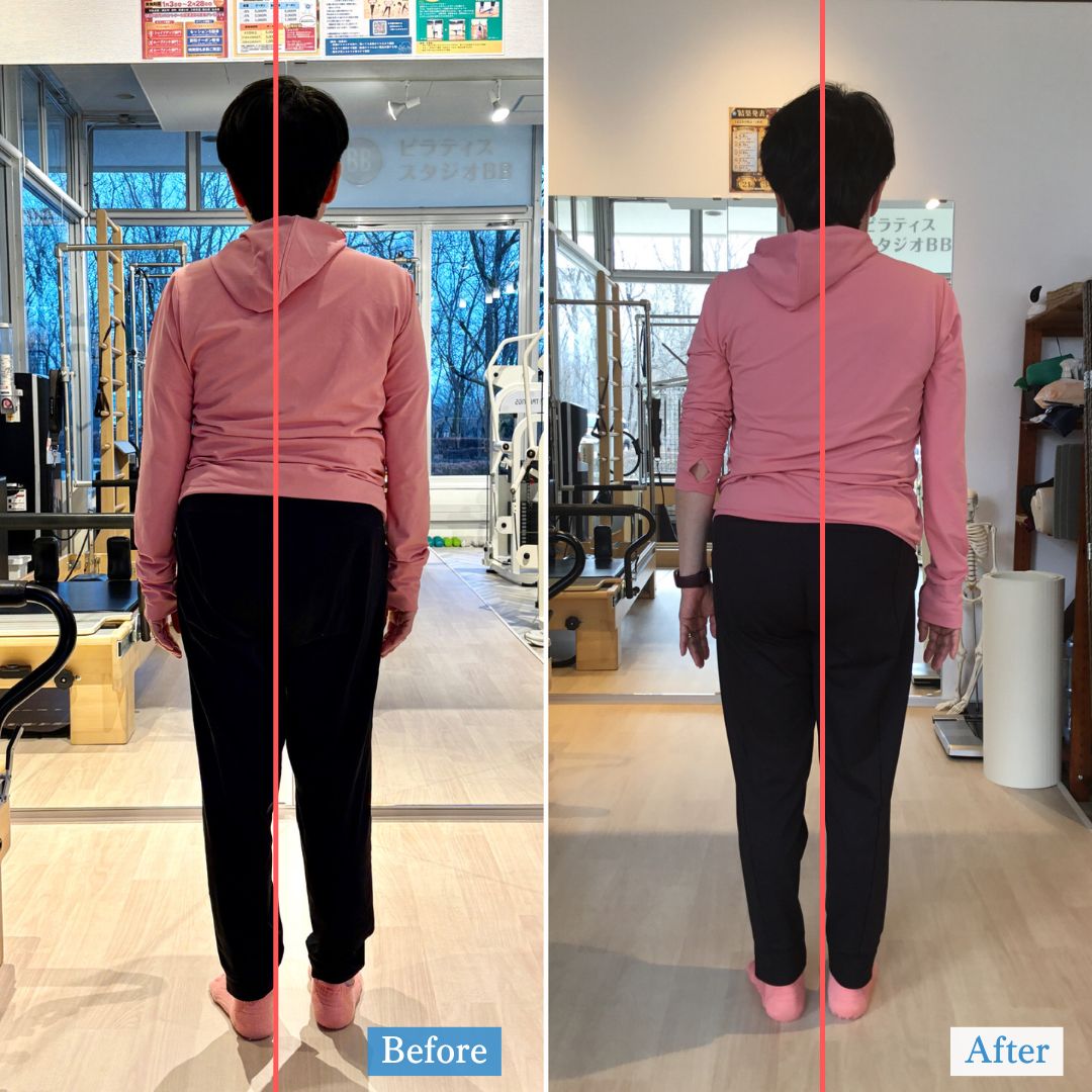 【60代女性】脊柱管狭窄症×側弯症でも姿勢は変わる｜ピラティススタジオBB仙台泉