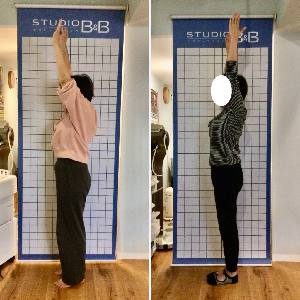 横向きでバンザイをしているM.N様の比較写真
