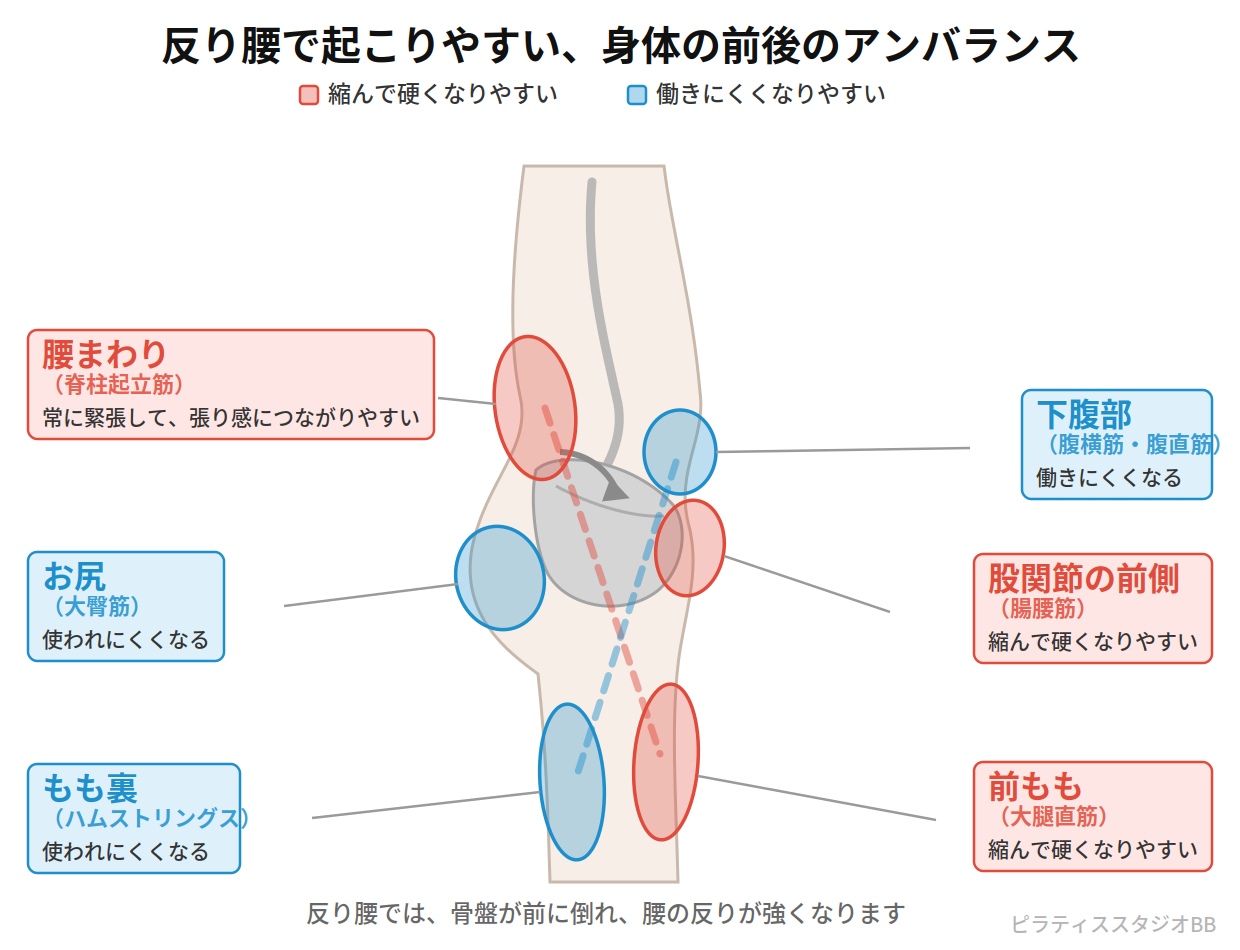 反り腰（骨盤前傾）で縮んで硬くなりやすい部位と、働きにくくなりやすい部位を示した図
